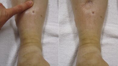 Photo of EDEMA